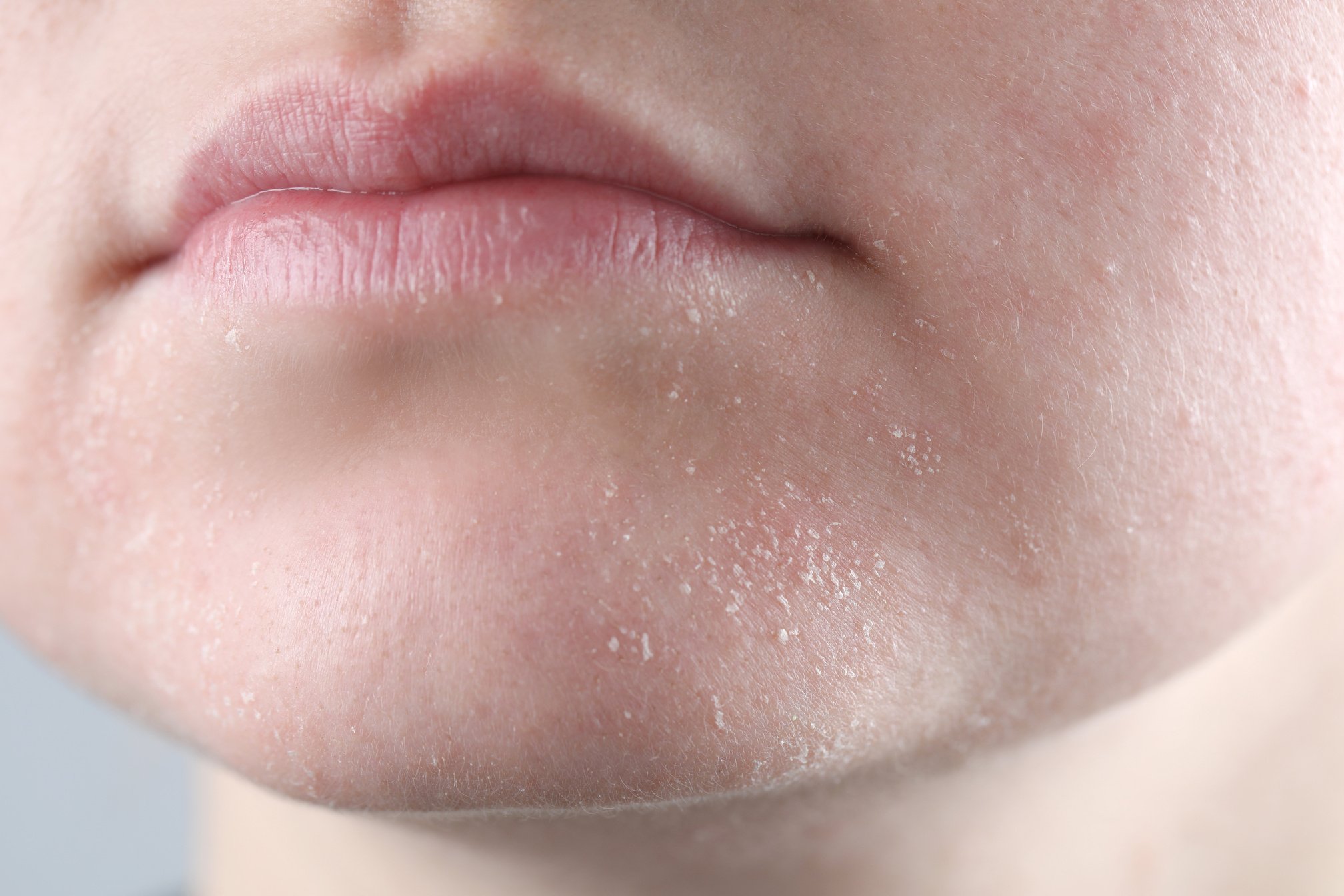 Woman with Dry Skin on Face against Light Grey Background, Close